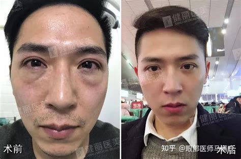 眼袋深面相男